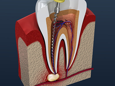 Platinum Endodontics | Cracked Teeth, Apicoectomy and Emergency Treatment