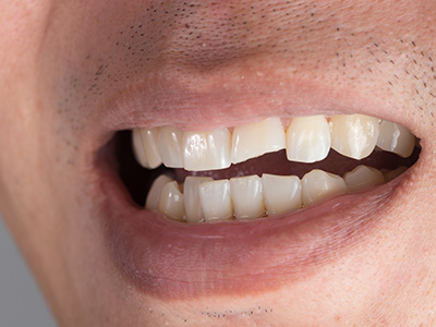 Platinum Endodontics | Emergency Treatment, Nitrous Oxide Sedation and Cracked Teeth