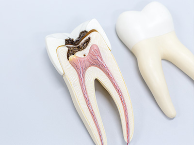 Platinum Endodontics | Nitrous Oxide Sedation, Cracked Teeth and Emergency Treatment